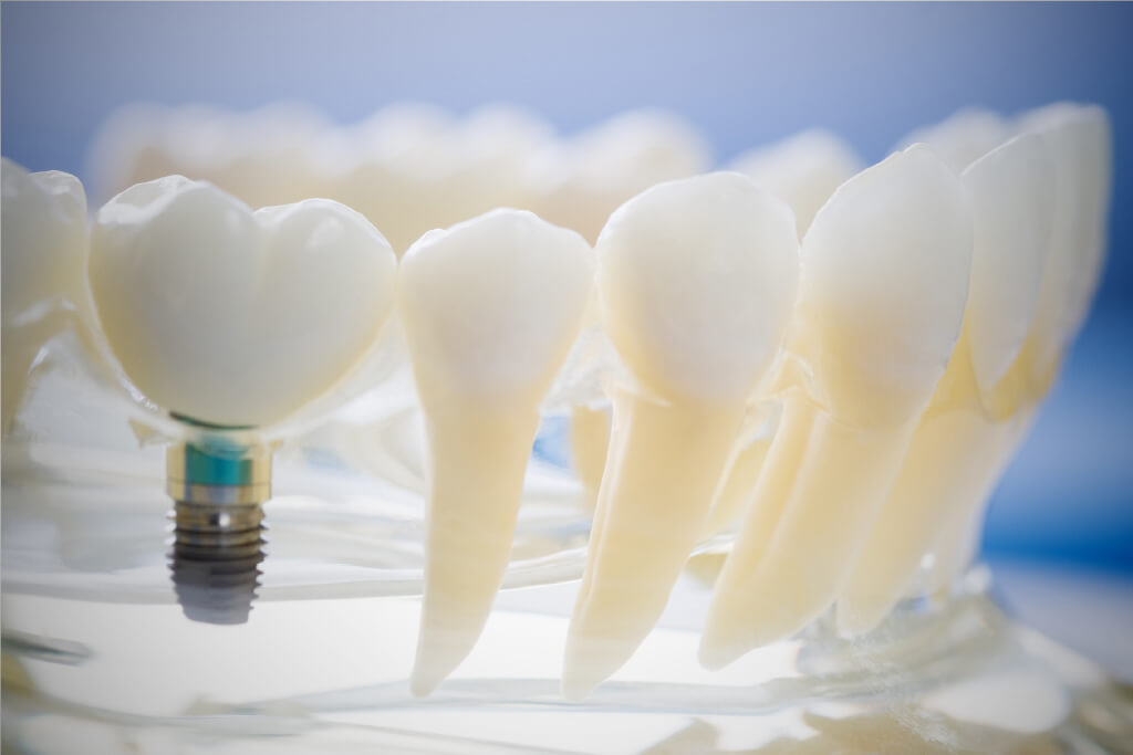札幌市東区・札幌プレミアム歯科・残存歯と口腔全体を守る将来を考えたインプラント治療